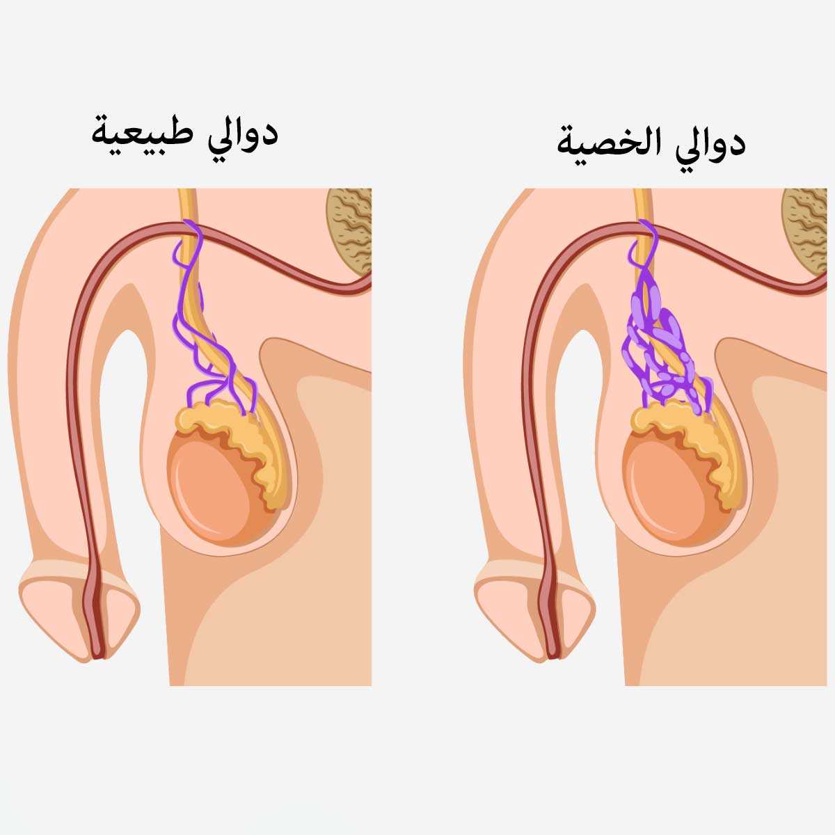 كيف تعلم أنك مصاب بدوالي الخصيتين؟ - دكتور أحمد فودة